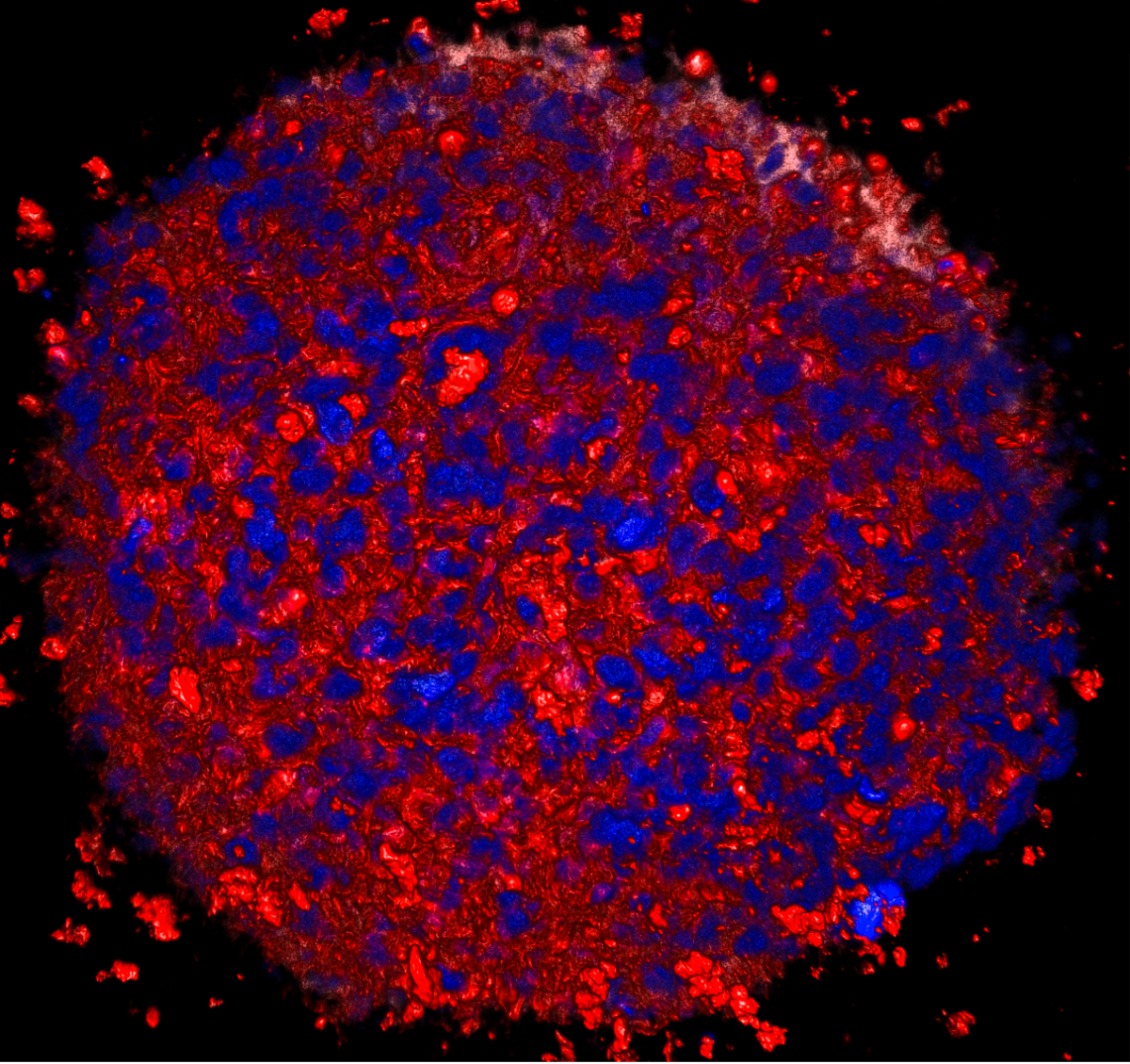 Cancer cell printed from a bio-printer